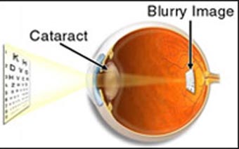 Cataract Unit