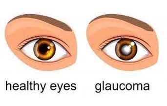 Glaucoma Management