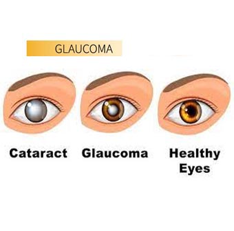 Glaucoma Management