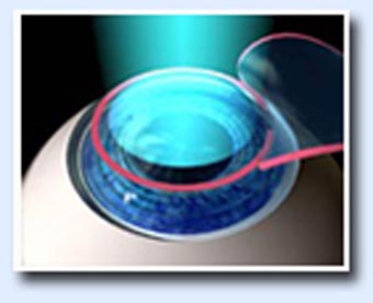 Lasik surgery