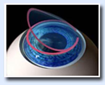 Lasik surgery