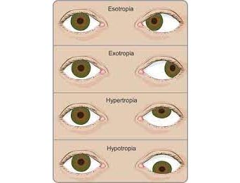 Squint & Oculoplasty Management