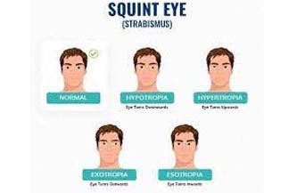 Squint & Oculoplasty Management